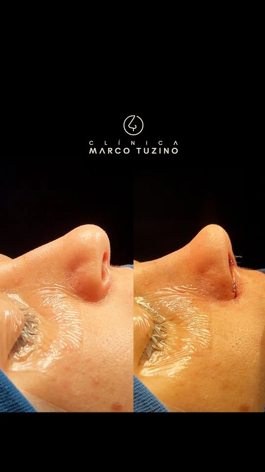 Cada detalhe faz a diferença no resultado final. A técnica refinada garante harmonia e naturalidade!

📲 Quer saber mais? Agende sua avaliação através do link da bio.

#Rinoplastia #NarizPerfeito #Naturalidade #AntesEDepois #DrMarcoTuzino