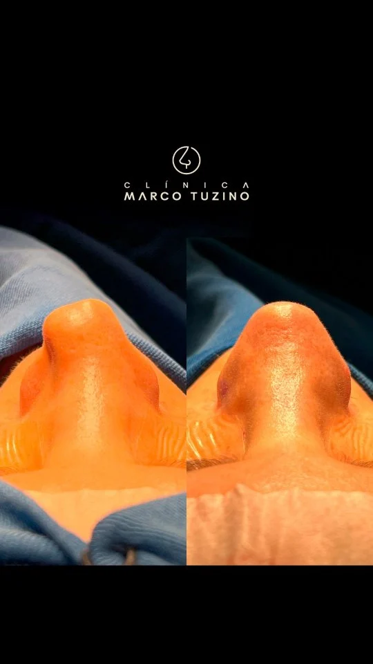 Finalizando mais uma semana repleta de transformações incríveis com #rinoplastiamarcotuzino. 🙏

Rinoplastia terciária com uso de cartilagem costal. 

Gostou deste resultado? Vamos conversar!

👃
👃🏻
👃🏼
👃🏽
👃🏾
👃🏿

#drmarcotuzino #rinoplastia #nariznatural