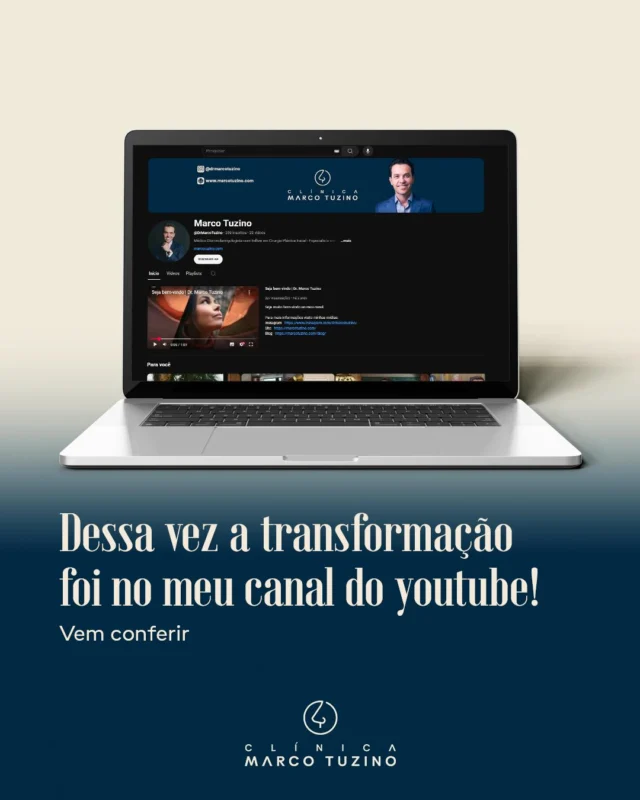 Meu canal no YouTube está de cara nova — literalmente! 
 
Acabamos de atualizar vídeos novos e aproveitei pra dar uma repaginada completa no canal. Tudo isso pra deixar o conteúdo ainda mais acessível, informativo e com a minha identidade.

Se você quer entender melhor sobre rinoplastia, tirar dúvidas sobre o pré e pós operatório, ou simplesmente se interessa pelo assunto, esse conteúdo é pra você!

🎥 Os novos vídeos estão imperdíveis — explicativos, objetivos e feitos com muito cuidado pra te ajudar a tomar decisões com segurança.

🔔 Dá uma passada lá, se inscreva e ative o sininho pra acompanhar essa nova fase comigo!

 👉 [Link do canal disponível na bio]