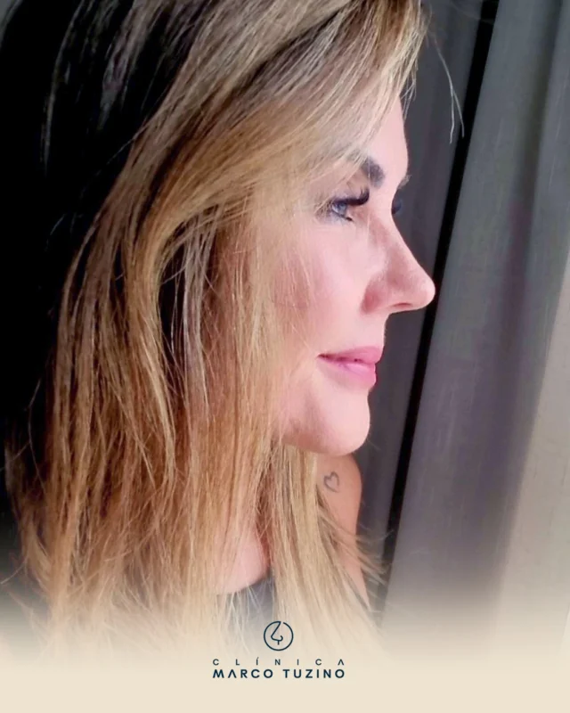 Resultado de uma rinoplastia com muita naturalidade, 6 anos de pós operatório. 😍

👃
👃🏻
👃🏼
👃🏽
👃🏾
👃🏿

#RinoplastiaCampinas #DrMarcoTuzino #Rinoplastia
