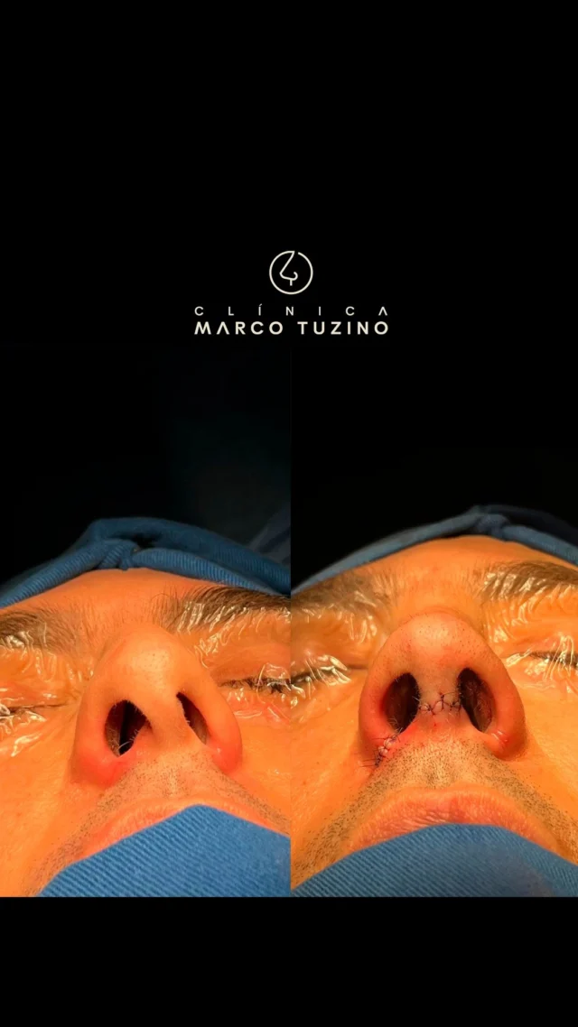 Mais uma semana repleta de transformações com #rinoplastiamarcotuzino. 🙏

👃
👃🏻
👃🏼
👃🏽
👃🏾
👃🏿

#ClinicaMarcoTuzino #rinoplastia
