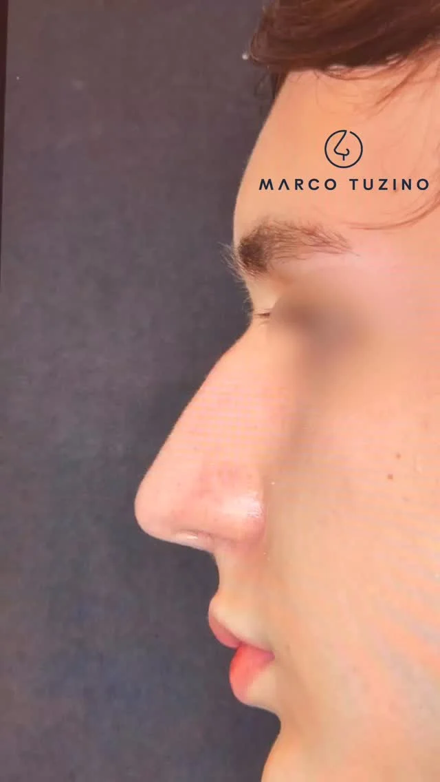 Seguimos na busca pela naturalidade👃

#Rinoplastia #rinoplastiamarcotuzino