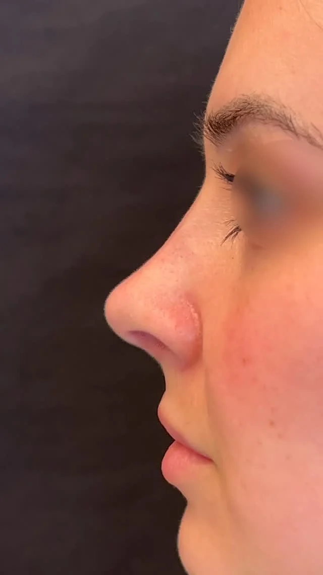 Existem inúmeras técnicas que podem ser utilizadas para a realização de uma rinoplastia. Sabe qual a melhor delas? Aquela que se encaixa melhor para o seu nariz. 👃 

Não existe uma técnica que seja boa para todos os casos. Por isso, a escolha de um cirurgião capacitado em rinoplastia e experiente é tão importante. 😷