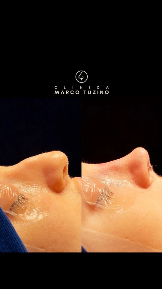 Mais um sonho realizado com #rinoplastiamarcotuzino. 🙏

Assista até o final e deixe seu comentário sobre o que achou desse resultado.

👃
👃🏻
👃🏼
👃🏽
👃🏾
👃🏿

#drmarcotuzino #rinoplastiacampinas #nariznatural #rinoplastia