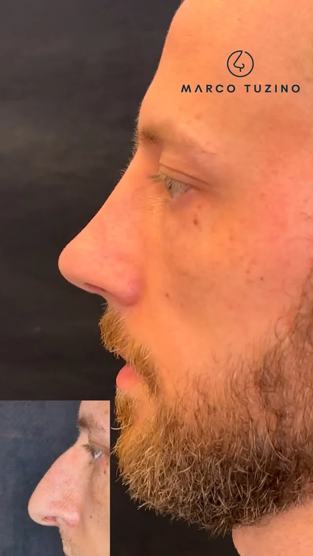 A #rinoplastia no nariz masculino tem as suas particularidades. 👃

Neste caso fica bem evidente como a relação entre a posição do dorso e a ponta do nariz devem estar em harmonia para um bom resultado. 📐 

Se você tem alguma dúvida ou alguma observação, deixe-a nos comentários que eu vou responder. 🙋🏻‍♂️