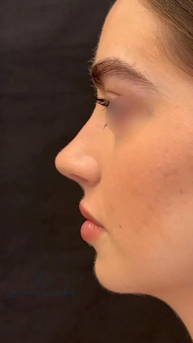 Com enorme satisfação divido com vocês esse lindo resultado. Nesta paciente fizemos uma rinoplastia estruturada e o que salta aos olhos é a naturalidade do resultado. Paciente e cirurgião extremamente satisfeitos. 😁

Gostaria muito de saber sua opinião, comente aqui!