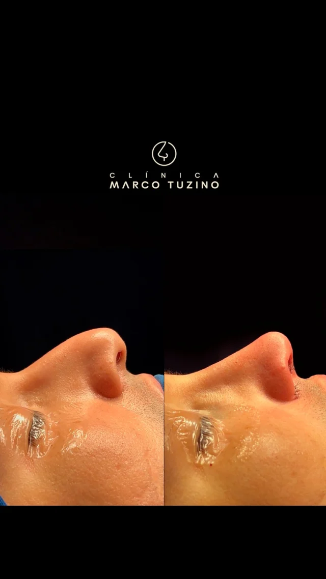 #rinoplastiamarcotuzino com muita Naturalidade 🥰

Me conte nos comentários o que achou desse resultado ⬇️

👃
👃🏻
👃🏼
👃🏽
👃🏾
👃🏿

#drmarcotuzino #rinoplastia