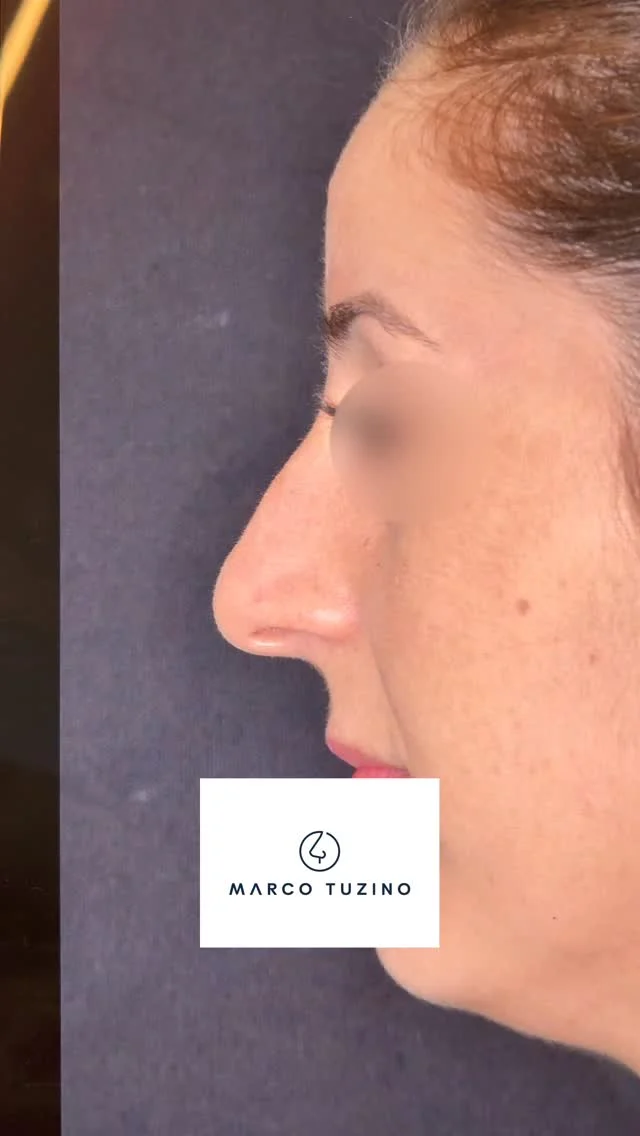 Apenas 50 dias de pós operatório, mas já podemos ver uma enorme diferença, com muita naturalidade!
E você, gostou?