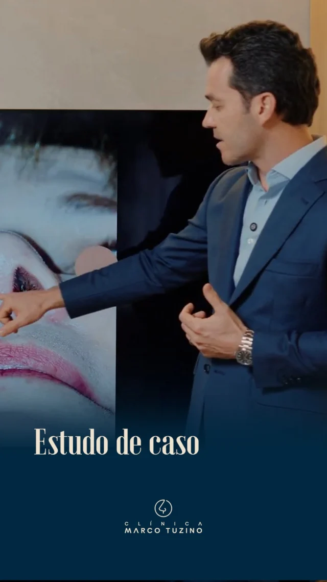 Hoje damos início a uma série de vídeos gravados com o objetivo de informar não somente os meus pacientes, mas também colegas médicos, otorrinolaringologistas e cirurgiões plásticos, que me acompanham e estão interessados em se aprimorar dentro do universo da rinoplastia. 

Caso 1:
Paciente insatisfeita com o seu nariz estética e funcionalmente. Queixa-se de que o nariz é torto, largo e ainda com importante obstrução nasal especialmente à direita. Apresenta em seu histórico uma rinoplastia realizada há mais de 20 anos.

Gostou desse conteúdo? Conta nos comentários! 🥰

👃
👃🏻
👃🏼
👃🏽
👃🏾
👃🏿

#DrMarcoTuzino #Rinoplastia  A rinoplastia é um procedimento complexo e delicado que requer habilidades especializadas. É essencial que pacientes e cirurgiões discutam expectativas, riscos e benefícios da cirurgia.
Esta publicação tem caráter educativo e não deve ser interpretada como uma promessa de resultado. As imagens são ilustrativas do caso em questão e foram utilizadas com autorização do paciente
As imagens apresentadas são do pós-operatório imediato, estando de acordo com o planejado.
Entretanto, é necessário aguardar um certo tempo para que todo o processo cicatricial esteja completo, para que possamos então realizar uma avaliação mais precisa do resultado final.
Demonstração conforme disposição do art. 14 || alínea
"b" da área. 2.336/2023 do CFM.