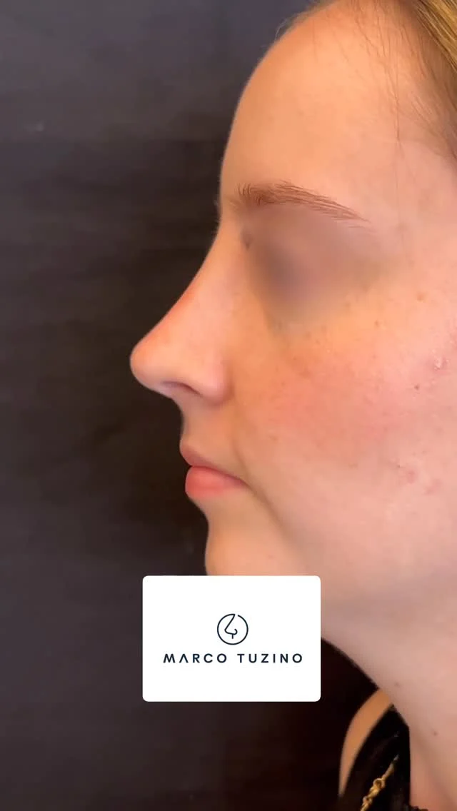 Esse é um nariz que tenho muita satisfação em dividir com vocês. Nele vocês pode ver claramente que a naturalidade impera, mesmo com uma grande mudança. Essa é a minha ideia de nariz ideal, vocês concordam comigo?