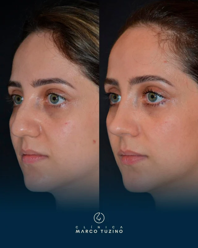 ▶ Antes: a paciente se queixava de que seu nariz era grande e largo, se incomodava bastante com a giba e com o formato da ponta do nariz (em bolinha).

▶ Cirurgia: realizamos uma Rinoplastia primária com via de acesso aberta. Foi feita redução do dorso com reconstrução do teto nasal utilizando auto spreader-grafts. 
Também foi feito ajuste da pirâmide óssea com osteotomias laterais e paramedianas, reposicionamento da ponta com auxílio do extensor septal mais técnica de tongue in groove.
Colocamos alar rim grafts livres para melhoria do contorno da margem alar.

▶ Depois: Tivemos como resultado um nariz proporcional e natural, respeitando os traços da paciente e valorizando sua identidade facial.

Notem o nariz mais estreito e com melhor relação dorso (reto) / ponta (mais projetada, definida e com rotação adequada).

👃
👃🏻
👃🏼
👃🏽
👃🏾
👃🏿

#RinoplastiaCampinas #DrMarcoTuzino #Rinoplastia

A rinoplastia é um procedimento complexo e delicado que requer habilidades especializadas. É essencial que pacientes e cirurgiões discutam expectativas, riscos e benefícios da cirurgia.
Esta publicação tem caráter educativo e não deve ser interpretada como uma promessa de resultado. As imagens são ilustrativas do caso em questão e foram utilizadas com autorização do paciente
As imagens apresentadas são do pós-operatório imediato, estando de acordo com o planejado.
Entretanto, é necessário aguardar um certo tempo para que todo o processo cicatricial esteja completo, para que possamos então realizar uma avaliação mais precisa do resultado final.
Demonstração conforme disposição do art. 14 || alínea
"b" da área. 2.336/2023 do CFM.