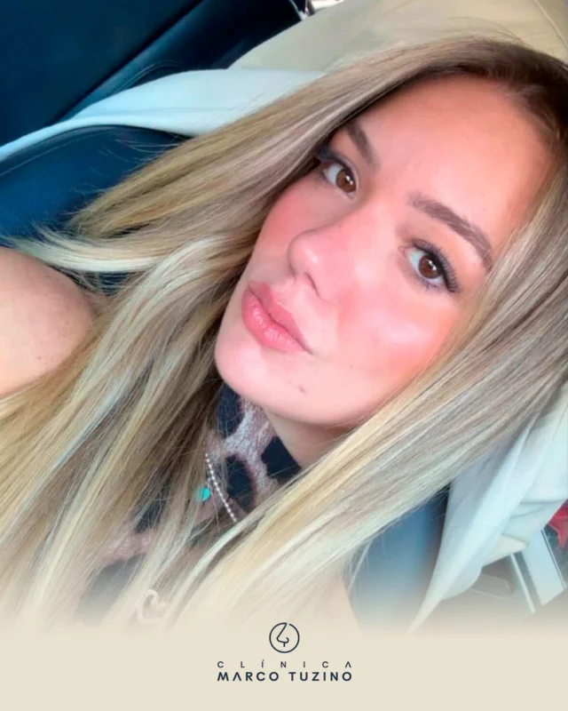 Naturalidade! 🥰

👃
👃🏻
👃🏼
👃🏽
👃🏾
👃🏿

#drmarcotuzino #rinoplastia