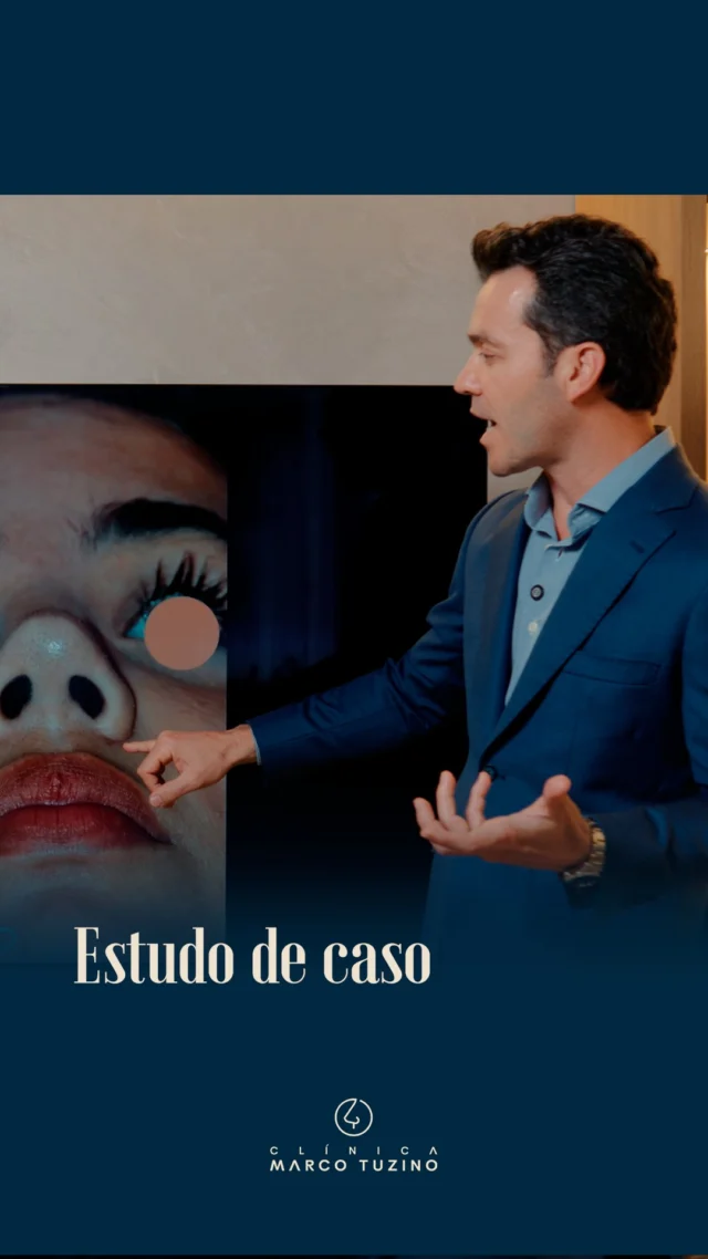 Dando continuidade na nossa série de estudos de caso, trago hoje um novo vídeo para aprofundarmos nossa discussão técnica e clínica. 👃✨

Como mencionei no vídeo anterior, este projeto visa compartilhar conhecimento tanto com meus pacientes quanto com colegas médicos que buscam se aprimorar na arte da rinoplastia. 

Acompanhe o vídeo e veja mais desse caso de uma Rinoplastia de paciente com a pele grossa.

Gostou desse conteúdo? Conta nos comentários! 🥰

👃
👃🏻
👃🏼
👃🏽
👃🏾
👃🏿

#DrMarcoTuzino #Rinoplastia A rinoplastia é um procedimento complexo e delicado que requer habilidades especializadas. É essencial que pacientes e cirurgiões discutam expectativas, riscos e benefícios da cirurgia.
Esta publicação tem caráter educativo e não deve ser interpretada como uma promessa de resultado. As imagens são ilustrativas do caso em questão e foram utilizadas com autorização do paciente
As imagens apresentadas são do pós-operatório imediato, estando de acordo com o planejado.
Entretanto, é necessário aguardar um certo tempo para que todo o processo cicatricial esteja completo, para que possamos então realizar uma avaliação mais precisa do resultado final.
Demonstração conforme disposição do art. 14 || alínea
"b" da área. 2.336/2023 do CFM.