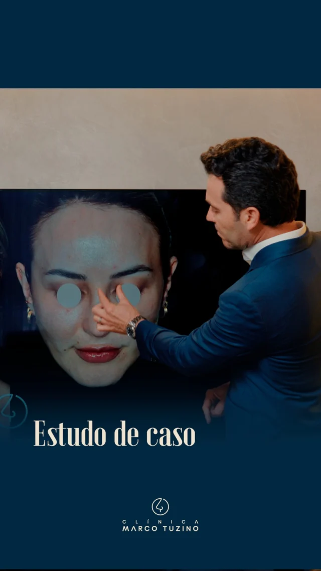 Avançando na nossa série de estudos de caso, trago hoje mais uma análise clínica para demonstrar a engenharia e o planejamento por trás de uma Rinoplastia. 📑✨

A proposta desta série é justamente abrir as portas do consultório: mostrar aos nossos pacientes o rigor técnico necessário para alcançar a naturalidade e, ao mesmo tempo, compartilhar com colegas médicos condutas cirúrgicas de alta precisão.

Assista o vídeo e deixe sua dúvida aqui nos comentários! 👇

#DrMarcoTuzino #Rinoplastia #EstudoDeCaso #Naturalidade